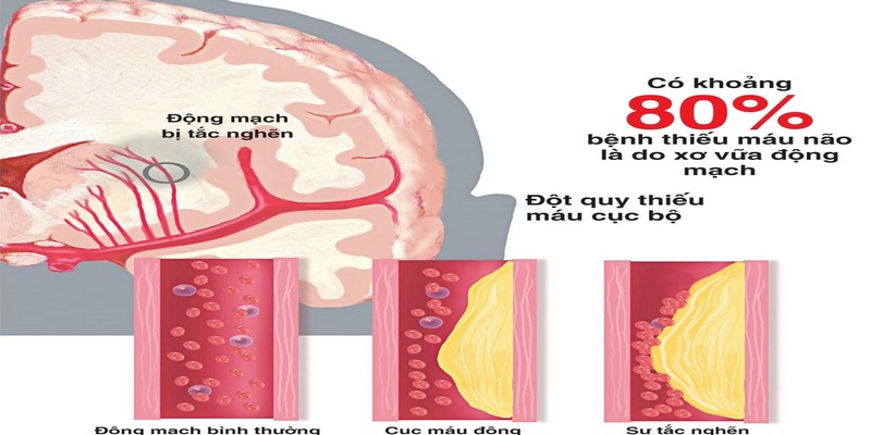 Rối loạn tuần hoàn não là gì?