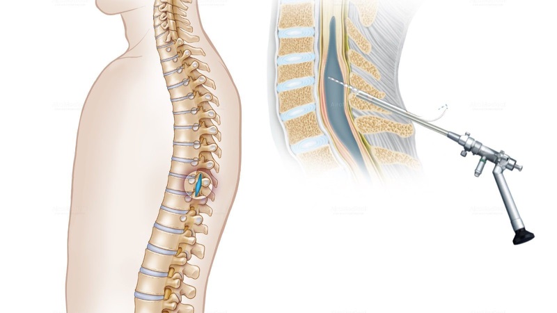 Rút dịch hốc tủy