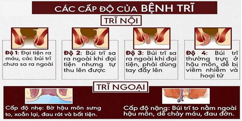 Các cấp độ của bệnh trĩ