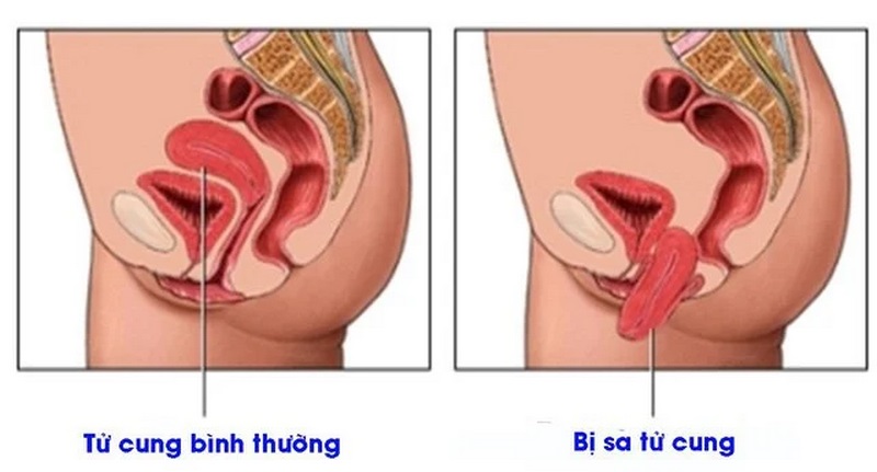 Tìm hiểu chung về sa sinh dục