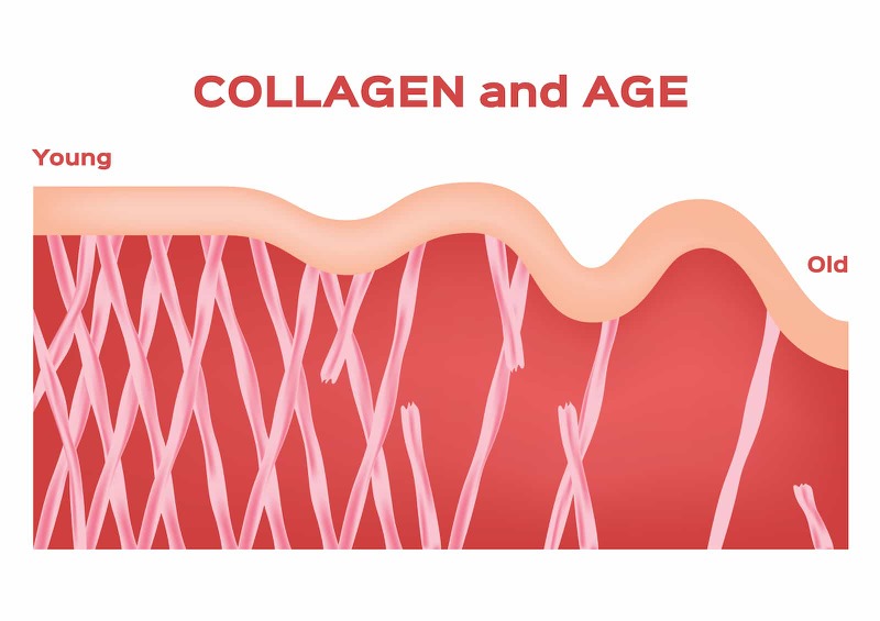 Theo thời gian, sự mất dần và đứt gãy collagen ảnh hưởng đến độ đàn hồi của da