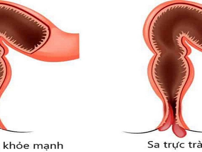 Đau hoặc khó chịu ở vùng hậu môn