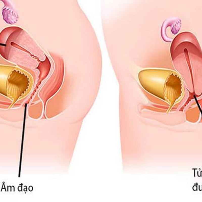 Tìm hiểu về sa tử cung