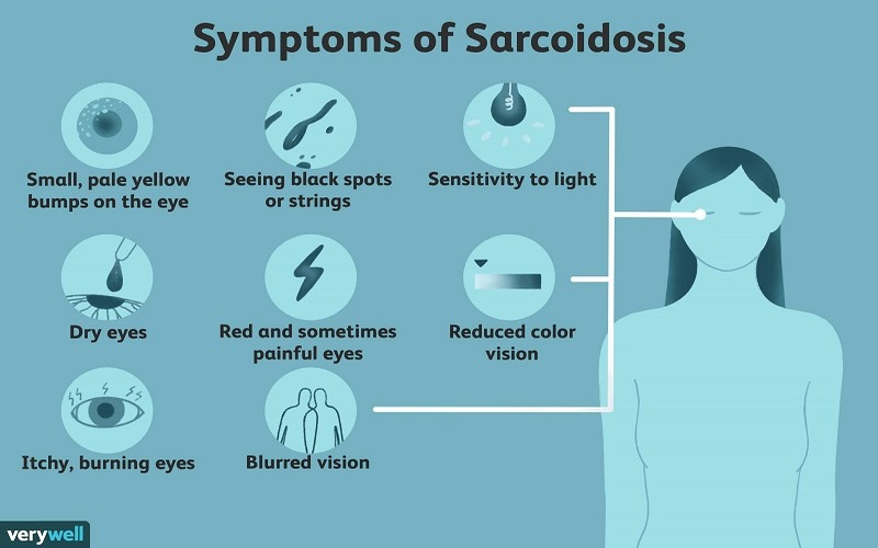 Sarcoidosis là một rối loạn đa hệ thống, căn nguyên chưa được biết rõ