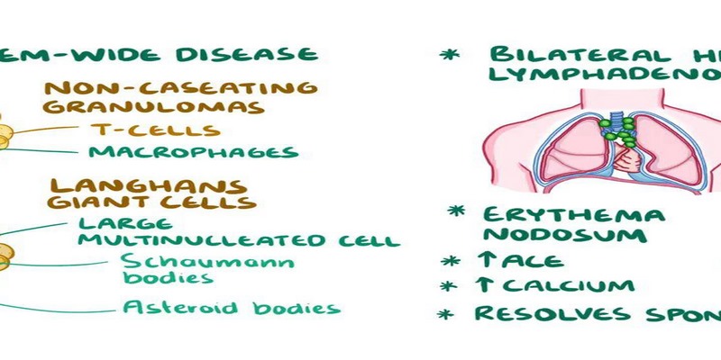 Sarcoidosis có thể ảnh hưởng đến phổi, gây ra cảm giác khó thở và đau ngực