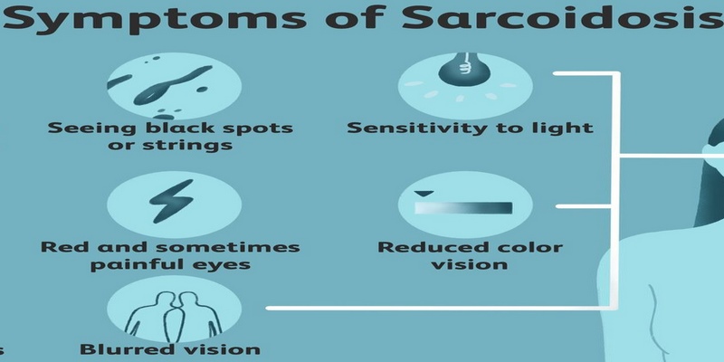 Sarcoidosis được coi là một bệnh liên quan đến hệ miễn dịch