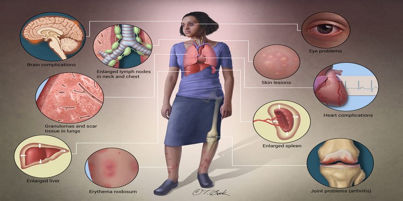 Sarcoidosis có thể gây tổn thương gan