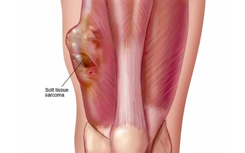 Sarcoma mô mềm là bệnh ung thư khá hiếm gặp