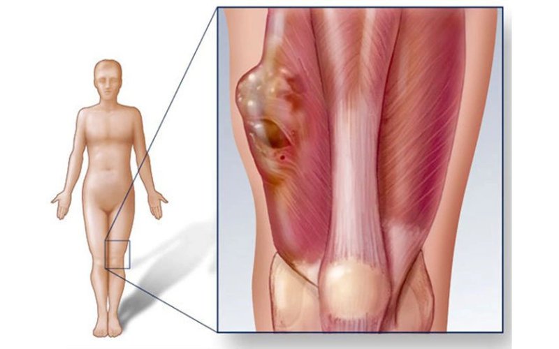 Sarcoma cơ vân được chia thành nhiều dạng khác nhau