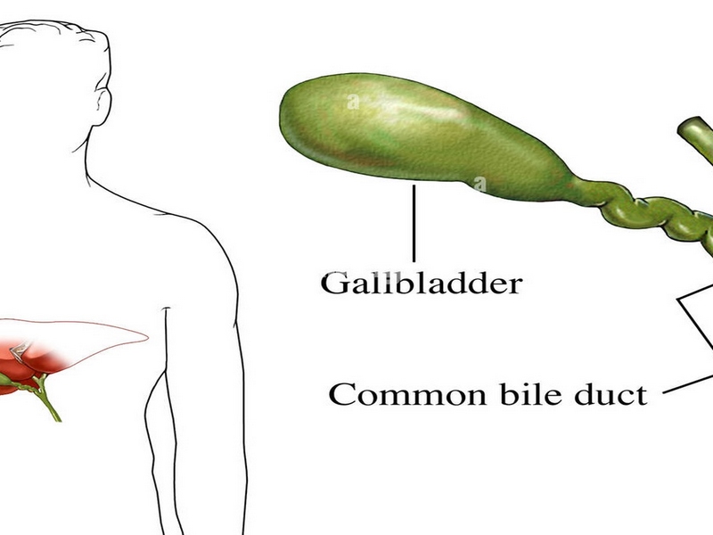 Sỏi ống mật chủ là gì?