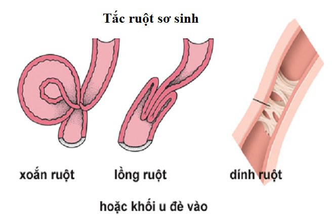 Những dấu hiệu và triệu chứng của bệnh Tắc ruột sơ sinh