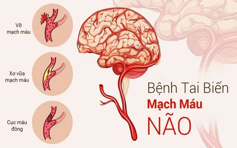 Nguy cơ tử vong cao vì tai biến mạch máu não