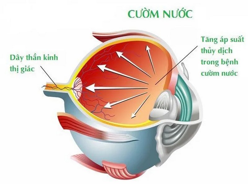 dấu hiệu và triệu chứng của Cườm nước