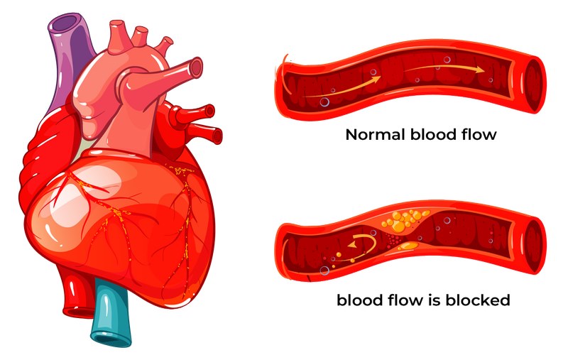 Tắc mạch vành ở tim có thể gây nhồi máu cơ tim