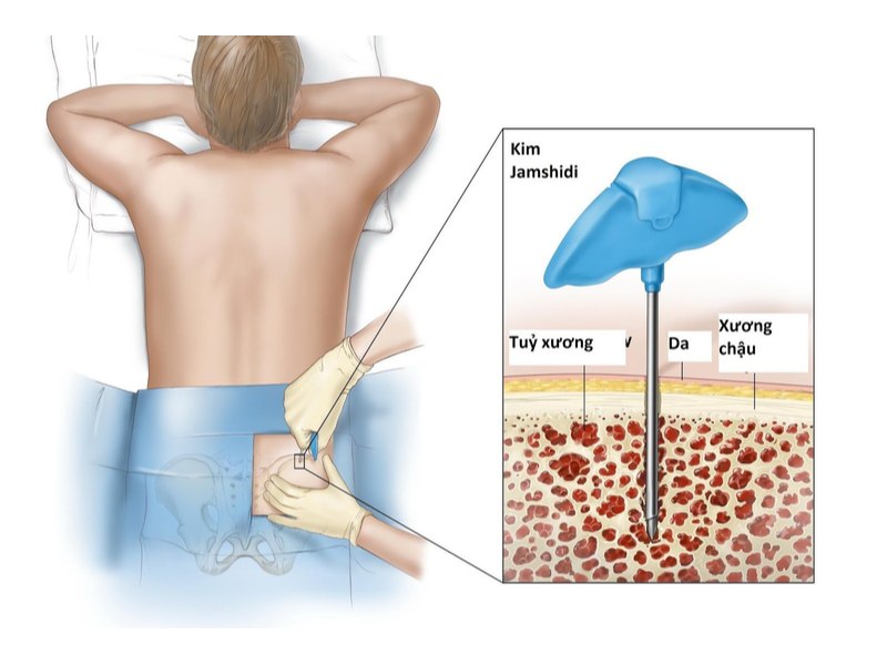 Sinh thiết tủy xương được dùng để chẩn đoán bệnh tăng tiểu cầu tiên phát