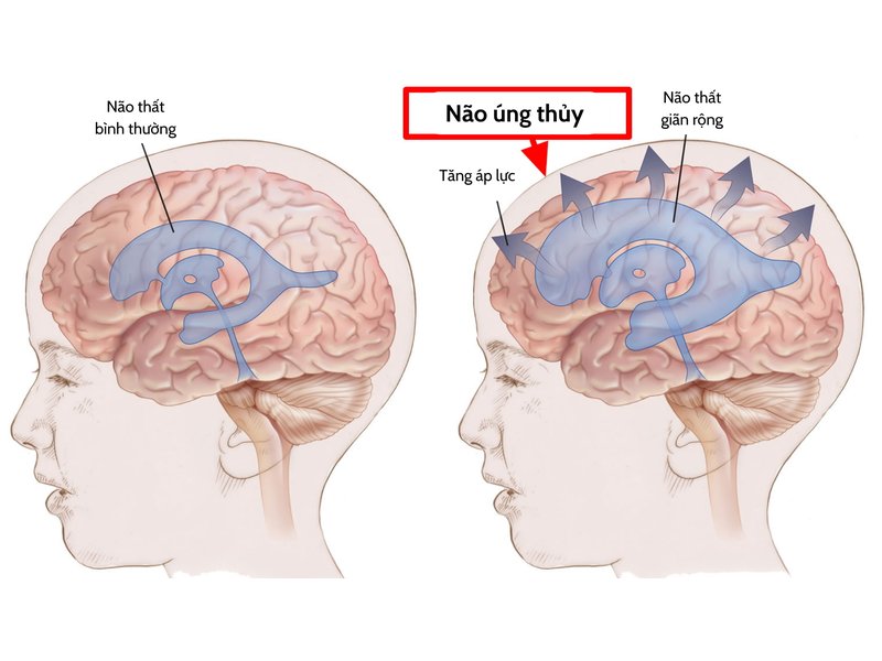 Não úng thủy là một trong những biến chứng của tật nứt đốt sống