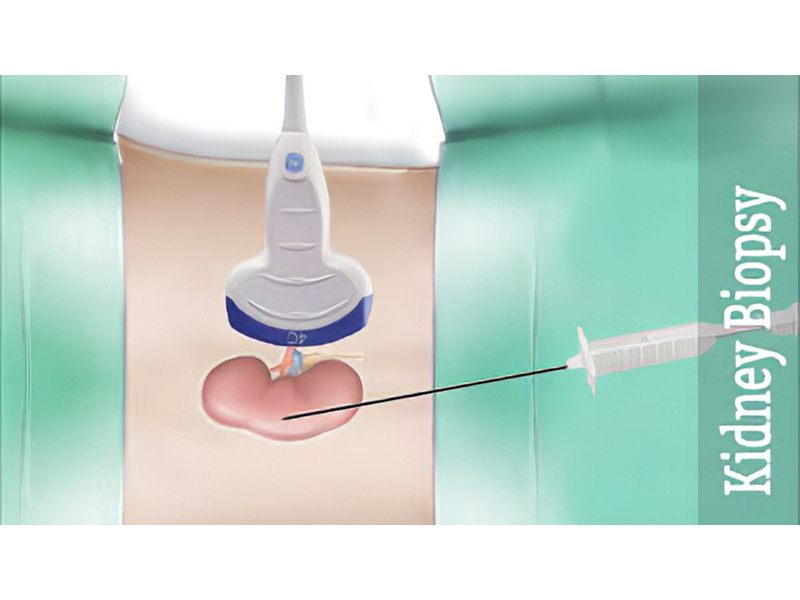 Sinh thiết thận giúp xác định mức độ tổn thương của thận