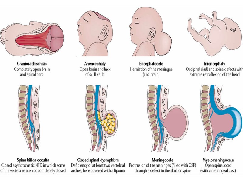 Thiếu một phần não xảy ra khi ống thần kinh của thai nhi không đóng lại 