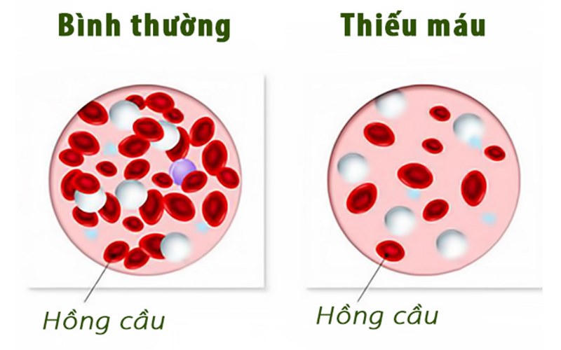 Thiếu máu là sự suy giảm hồng cầu và huyết sắc tố trong máu