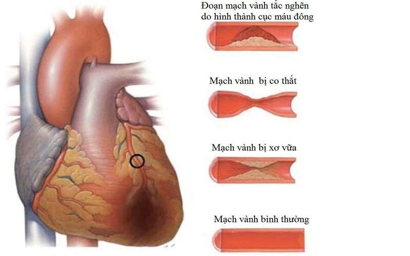 Thiếu máu cơ tim thường do hẹp tắc mạch vành