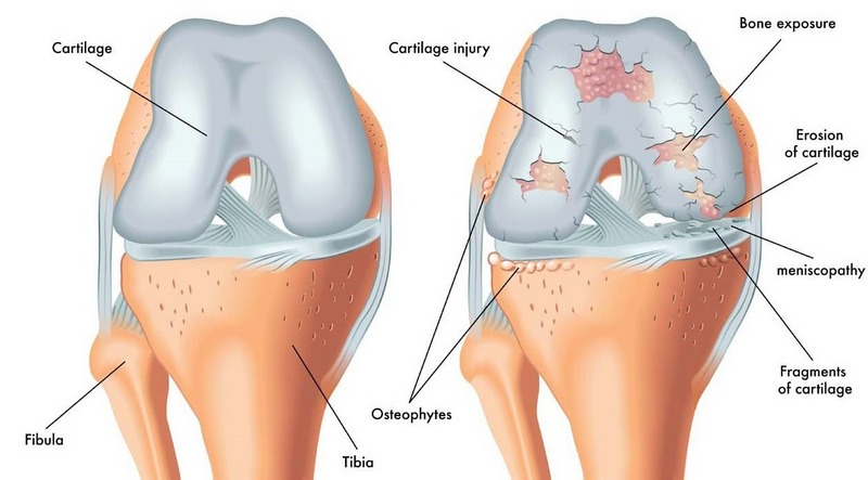 Phương pháp chuẩn đoán và điều trị thoái hóa khớp