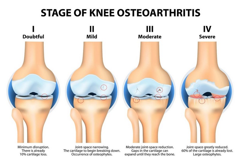 Thoái hóa khớp gối là gì? Nguyên nhân và cách điều trị