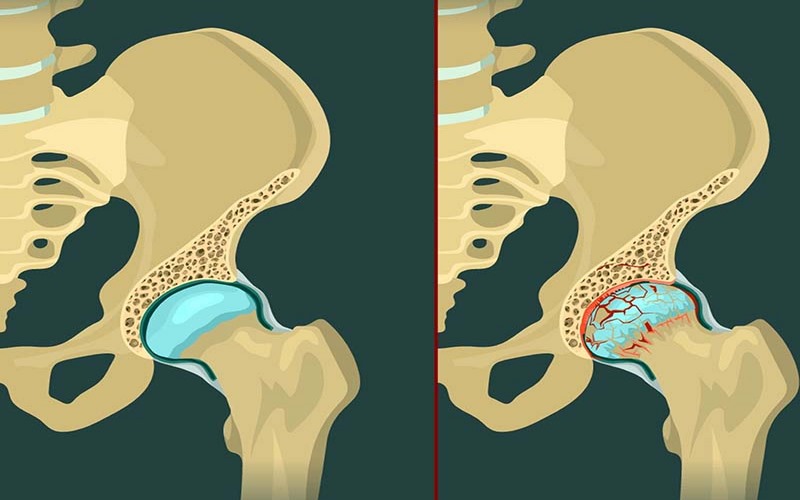 Viêm, sưng do thoái hóa khớp háng có thể được điều trị bằng cả nội khoa lẫn ngoại khoa