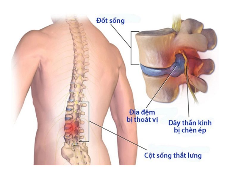 Thoái hóa cột sống thắt lưng là bệnh lý xương khớp mãn tính