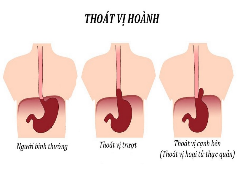 Người cao tuổi có nguy cơ cao hơn mắc phải thoát vị hoành cao