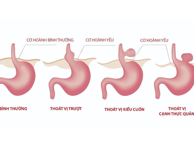 Thoát vị khe hoành là khi một phần của dạ dày trượt lên cơ hoành trong lồng ngực