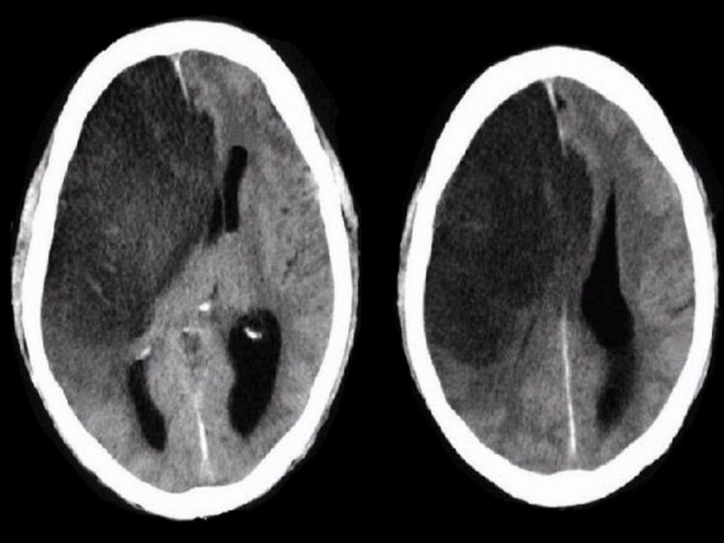 CT scan sọ não cho phép nhìn thấy rõ tình trạng thoát vị não