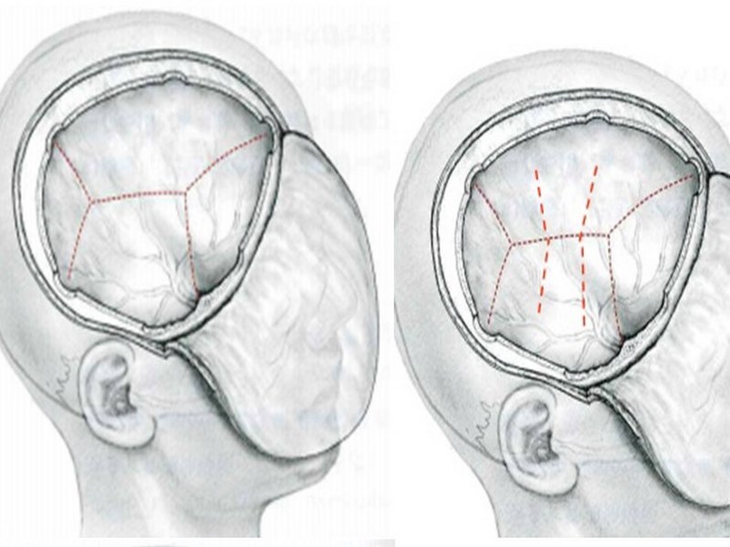 Mở sọ giải áp là một phương pháp hiệu quả