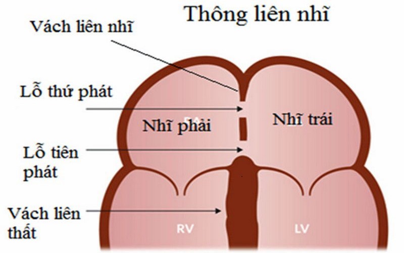 Vách liên nhĩ bắt nguồn từ vách nguyên phát