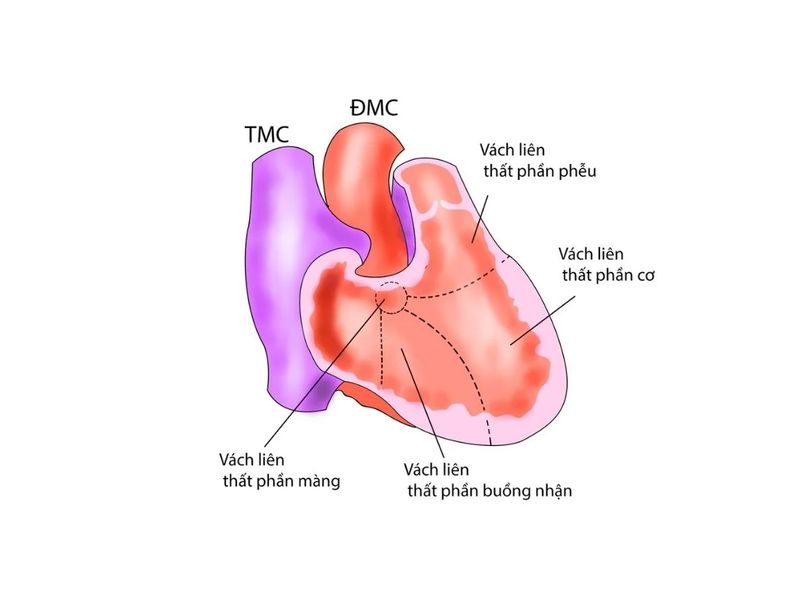 Thông liên thất phần phễu là dạng thông liên thất đặc biệt