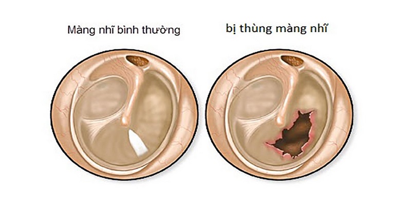 Tìm hiểu chung về thủng màng nhĩ