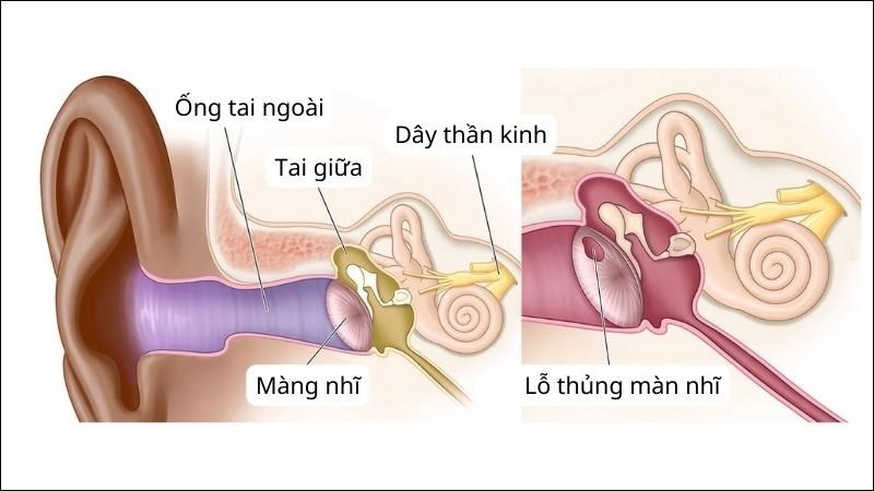 Bạn cần gặp ngay bác sĩ nếu bạn nghi ngờ mình bị thủng màng nhĩ