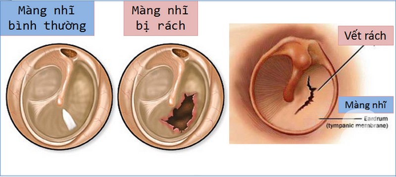 Bạn nên chú ý đến các dấu hiệu và triệu chứng thủng màng nhỉ