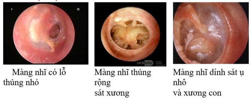 Bác sĩ sẽ tiến hành thăm khám bằng cách nghe và điều tiết âm thanh để xác định có thủng màng nhĩ hay không