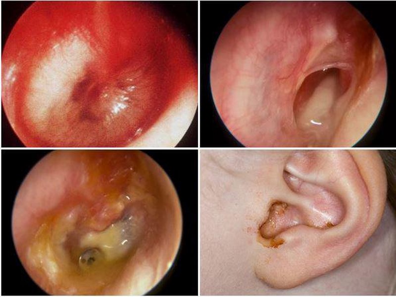 Chế độ sinh hoạt dành cho người bị thủng màng nhỉ