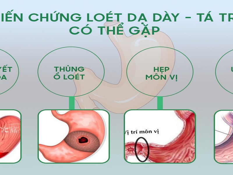 Thủng dạ dày là gì?