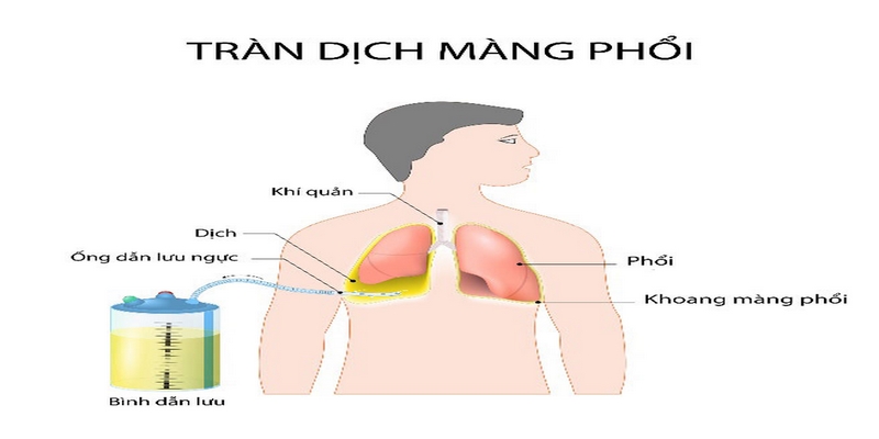 Tràn dịch màng phổi gây ra bởi nhiều nguyên nhân