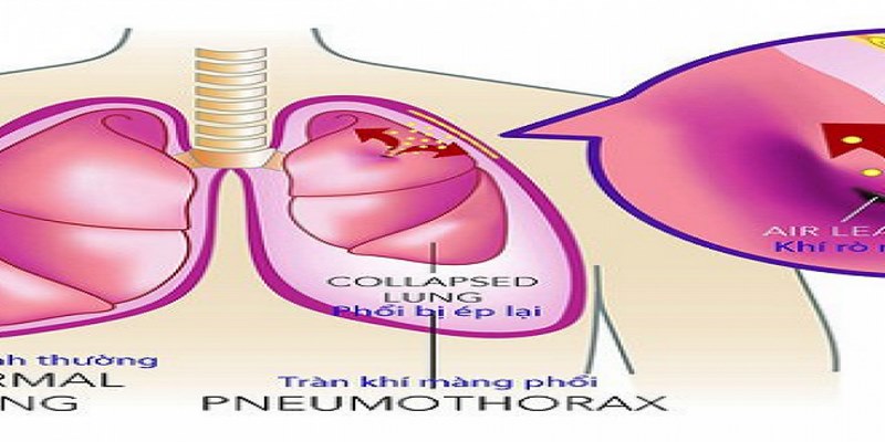 Hãy sử dụng các thiết bị hỗ trợ hô hấp hoặc hỗ trợ thông khí