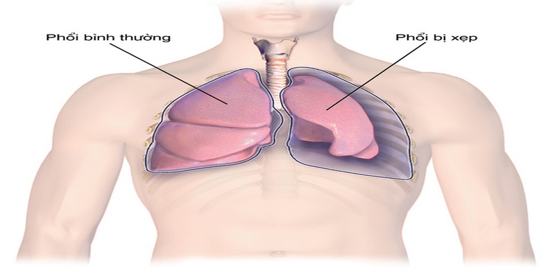 Tràn khí màng phổi là gì?