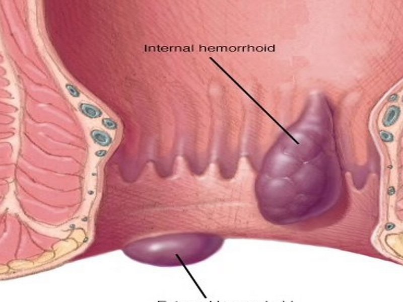 Táo bón dẫn đến áp lực lớn khi đi tiêu có thể làm tăng nguy cơ mắc trĩ