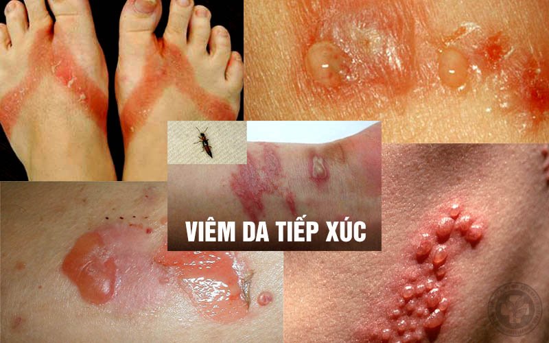 Có nhiều triệu chứng viêm da