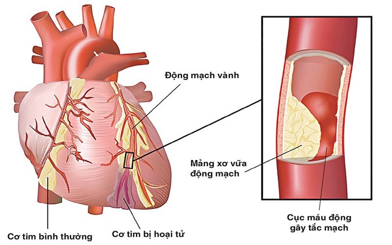 Trụy tim là một bệnh lý liên quan đến sự hoạt động của tim không đều, do sự kết hợp giữa các nhịp tim nhanh và chậm. Đây là hiện tượng thường gặp