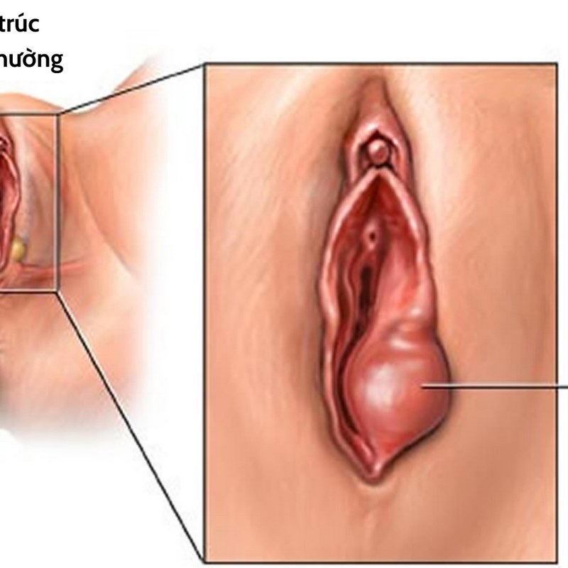 Tìm hiểu chung về U nang tuyến Bartholin