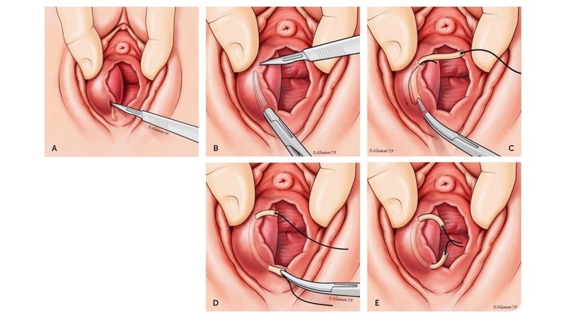 Phẫu thuật đặt ống thông tuyến Bartholin