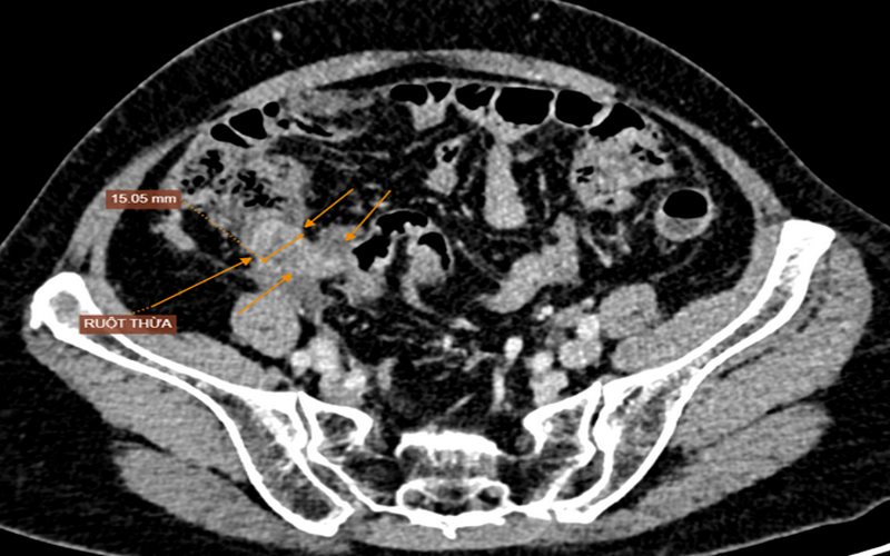 Hình ảnh chụp cắt lơp vi tính khối tổn thương vị trí hố chậu phải