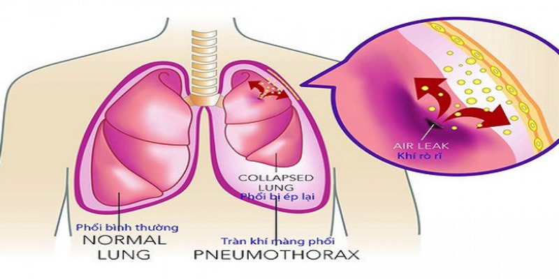 Tràn khí màng phổi là một biến chứng có thể liên quan đến phẫu thuật